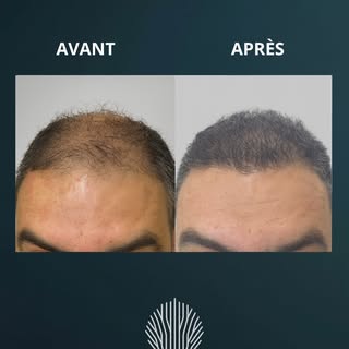 Évolution à 6 mois d’une greffe capillaire de la zone frontale+midscalp (moitié avant du cuir chevel