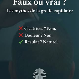 Greffe capillaire : démystifier pour mieux informer
De nombreuses idées reçues persistent autour de 