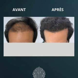 Résultat d’implant capillaire – Évolution à 7 mois
(L’aspect final sera atteint à 12 mois)
Grâce à u