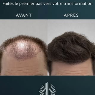 Une transformation capillaire visible et naturelle.
Restauration de la densité, redéfinition de la l