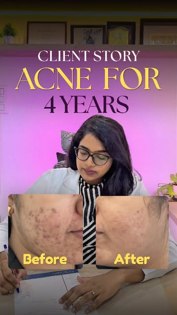 She had 4 years of acne and 3 months left before moving abroad.
Homeopathy, serums — nothing worked,
