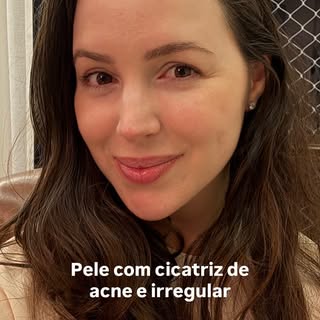 Cicatriz de acne pode deixar a pele com uma aparência muito mais irregular do que você gostaria.👇🏻