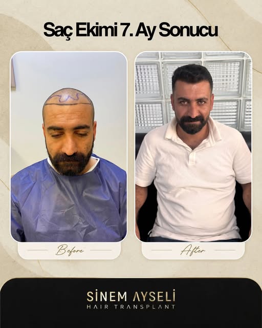📌 Uyarı: Paylaşımlarımız bilgilendirme niteliğindedir.
✅ Tüm cerrahi ve estetik işlemlerde sonuçlar