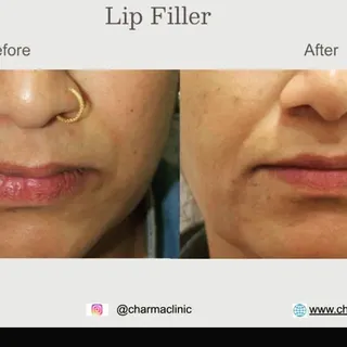 Lip filler are a type of dermal filler that add volume to your lips 
#dermatologist #dermatology #co