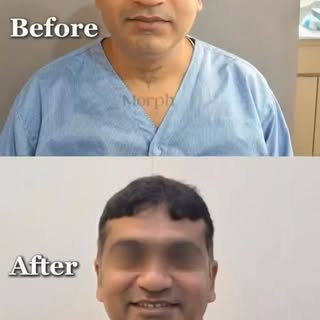 From Day 0 ➝ 6 Months Hair Transplant Result✨
A journey of growth, transformation & confidence at Mo