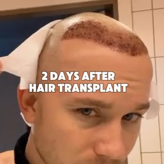 Aaron came all the way from West Virginia (US🇺🇸) to have his hair transplant at our clinic in Stoc
