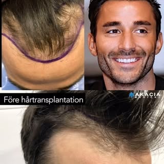 Har du tappat hår, och överväger en hårtransplantation? Gör som Alex D’Rosso och besök oss på Akacia