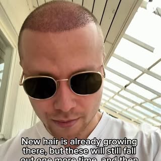 Videolla hiustensiirrosta on kulunut 10 päivää, ja saan pestä ruvet pois päästä hellävaroen!

*Hiust