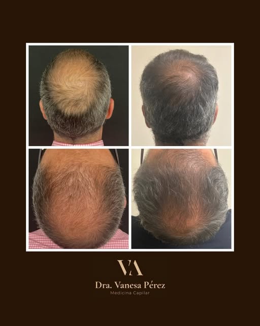 Resultado tras 6 meses de tratamiento capilar

 #trasplantecapilarespaña #tratamientocapilar #clinic