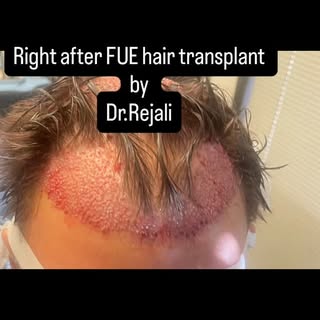 Restoring more than hair — restoring confidence.

Doctor-performed FUE hair transplant with meticulo