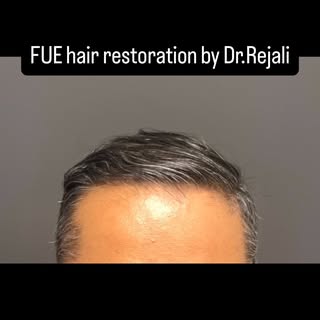 A natural hairline can make a remarkable difference—without looking like you’ve had a hair transplan