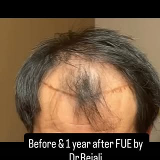 1-Year FUE Transformation ✨

One year. One procedure. A natural-looking result designed to last.

Th