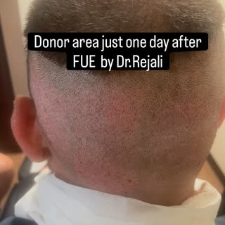 Quick healing starts with a gentle technique. ✨

Just 1 day after shaven FUE, the donor area is alre
