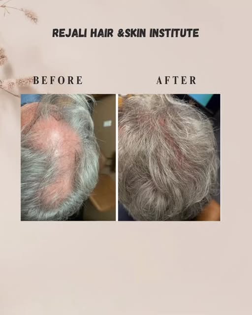 Frontal & Crown Restoration with FUE ✨

Before & after FUE hair transplantation performed by Dr. Rej