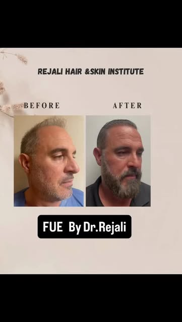 ✨ FUE Transformation — Before & 8 Months After

A remarkable transformation just 8 months after FUE 