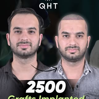 Zubair chose QHT. 2500 grafts later, here's the result. 💚

Full head of hair, natural hairline, and