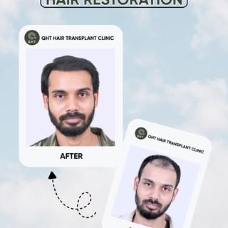 Start to finish — this is what a complete hair transplant journey looks like. 💚

Every graft handle