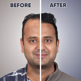 Flip the switch. See the difference. Ajay Singh's before and after. 💚

Receding hairline, thinning 