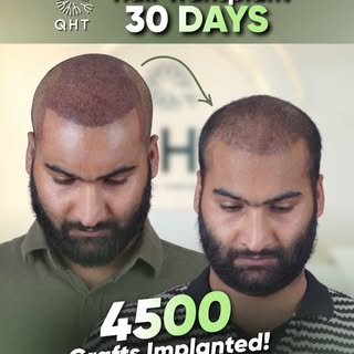 4500 grafts. 30 days in. Zeeshan says he wishes he'd done it sooner. 💚

"Jitni jaldi karwa liya hot