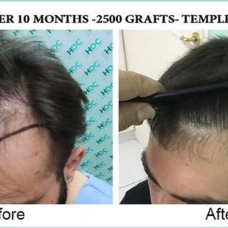 Before and After 10 months 2500 grafts temple replacement
#hair #hairloss #hairtransplant #hairresto