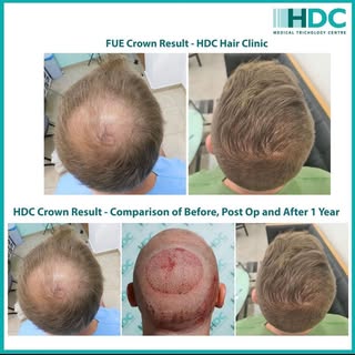 Restoration of the crown area.
#hair #hairloss #hairtransplant #hairtransformation #fue