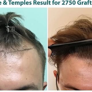 Hairline and Temples restoration with 2750 grafts
#hair #hairtransformation #hairtransplant #hairlos