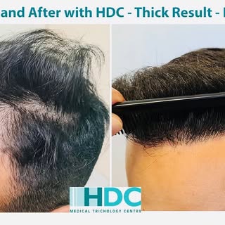 Before and After 3200 grafts FUE
#hair #hairtransformation #hairtransplant #hairtransplantsurgery #f