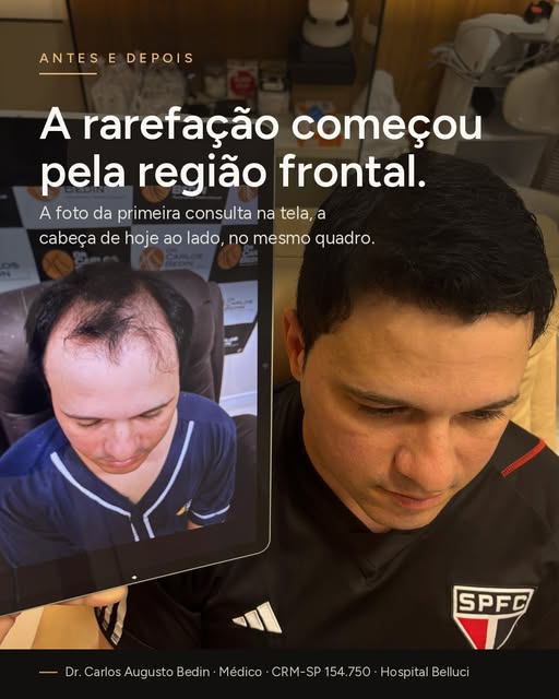 A rarefação começou pela região frontal.

Na imagem, a foto da primeira consulta está na tela, ao la