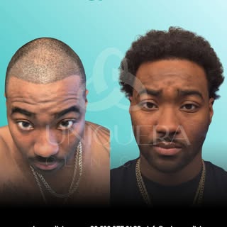 African Hair Restoration!

African hair requires a highly specialised approach. The natural curl and
