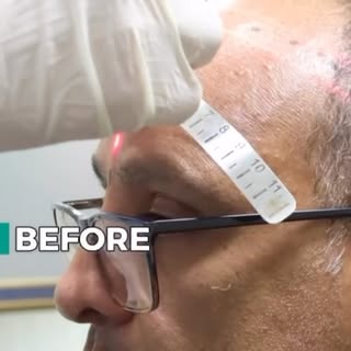 From the first consultation to a full, natural-looking head of hair. 🔥

Our patient came to us as a