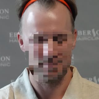 Look at this incredible natural transformation after fixing those temples with just one FUE Surgery.