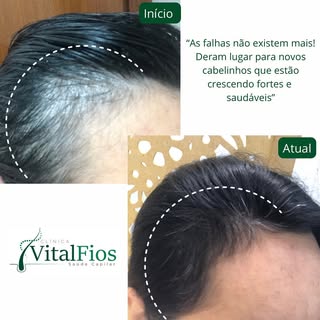 🛑PARE DE PERDER CABELO!.

Sim! É possível recuperar seus cabelos 🌿
Fale conosco 📲 Nós podemos te 