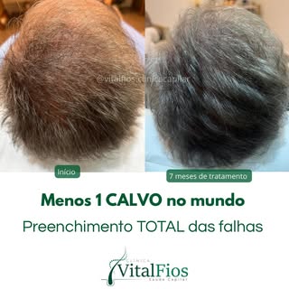 Sim! Calvície tem tratamento e ele não precisa ser cirúrgico. 

Com um protocolo personalizado, esti
