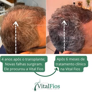 Esse paciente já havia passado por um transplante  cirúrgico há 4 anos, mas as falhas voltaram a apa