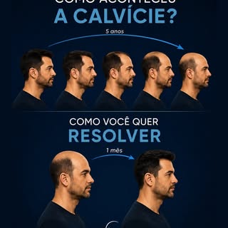 A calvície não acontece da noite para o dia.

Ela evolui aos poucos.

Primeiro vêm as entradas. Depo