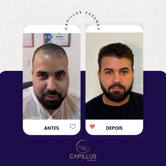 Um antes e depois que realça a naturalidade de um Transplante Capilar bem feito. 

Processo em evolu
