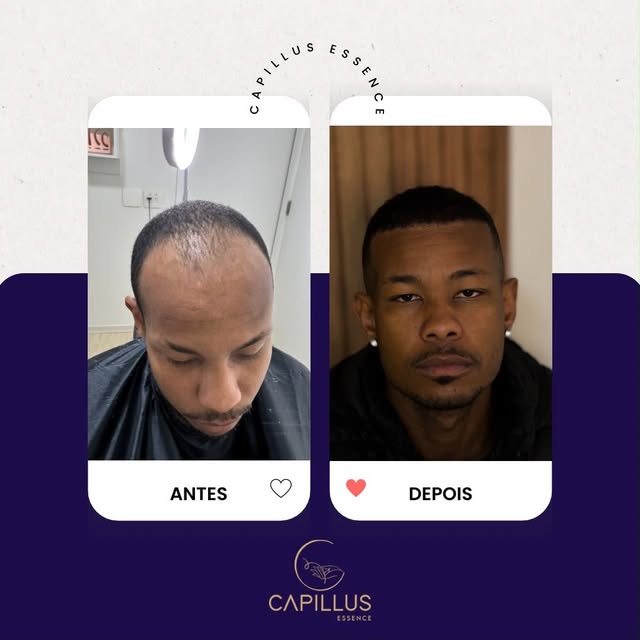 12 meses de diferença e o resultado é espetacular! 
Cabelo afro com Hairline natural e boa densidade