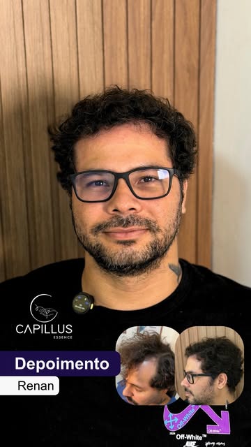 6 meses de transplante capilar e podemos dizer que o Renan rejuvenesceu muito ✨ 

Ainda temos um lon