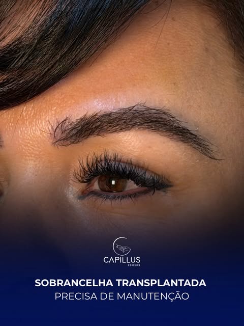Sobrancelha transplantada precisa de manutenção.

A técnica usa folículos do próprio couro cabeludo,