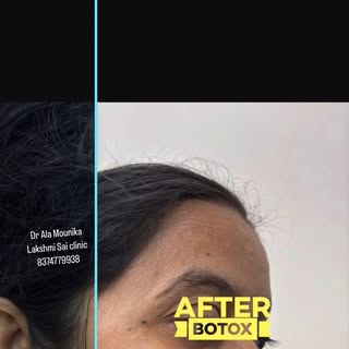 Expression lines making you look tired?
Botox is a quick , non surgical fix..
Results in just a few 