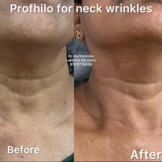 ✨ Say Hello to a Smoother, Younger-Looking Neck! ✨

Tired of neck wrinkles and sagging skin? Profhil