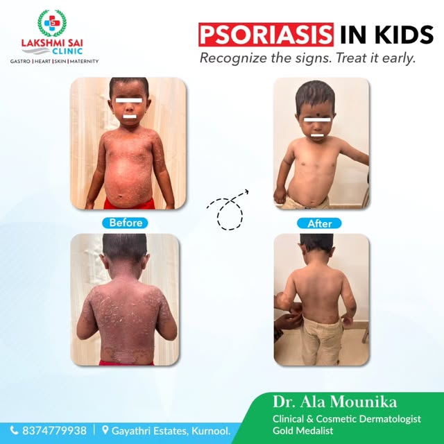 ✨ Psoriasis in Kids – Before & After Treatment ✨

Every child deserves healthy, comfortable skin. 💙