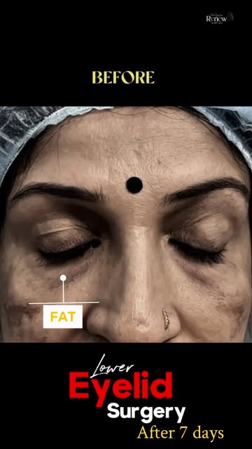 BLEPHAROPLASTY Before → After ✨

Precision blepharoplasty that brings out the natural beauty you des