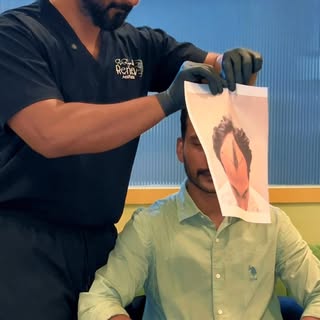 Real hair transplant results. Witness how precise hairline design and advanced FUE graft placement c