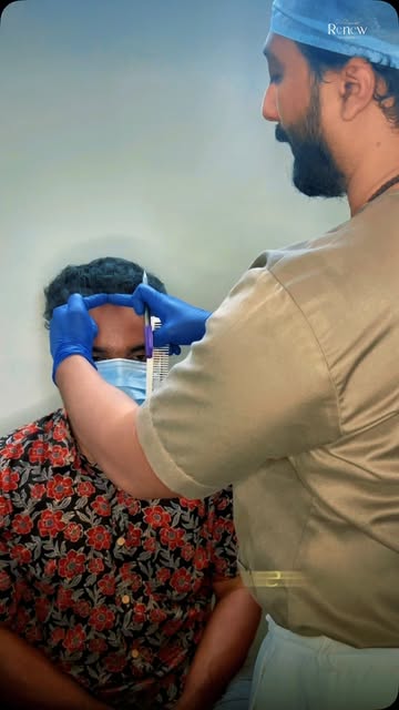 Bad hairline correction . Failed transplant? Let’s fix it.

Specialized hairline correction techniqu
