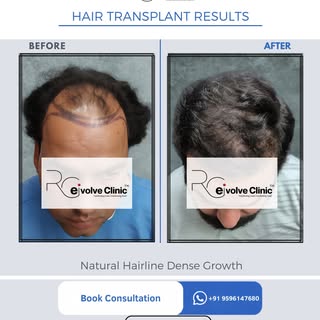 Real results speak for themselves. 👨‍⚕️

A receding hairline and thinning crown don’t have to be pe