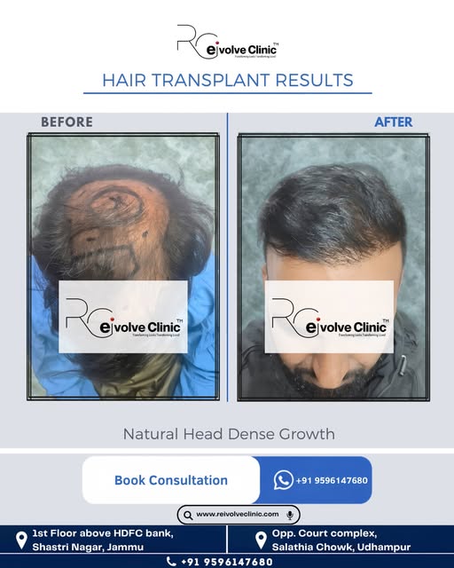 Real transformation, natural dense growth! 📈
See this remarkable hair restoration at Rei volve Clin