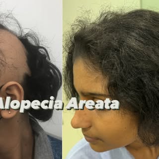 Full hair regrowth in a case of sudden onset rapidly spreading Alopecia Areata. #vikshaclinic #viksh