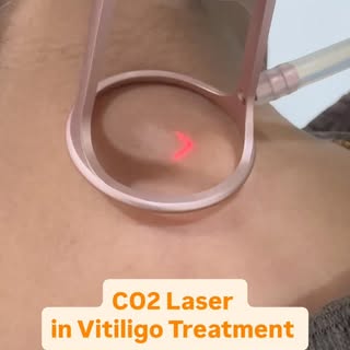 CO2 Laser in Vitiligo Treatment