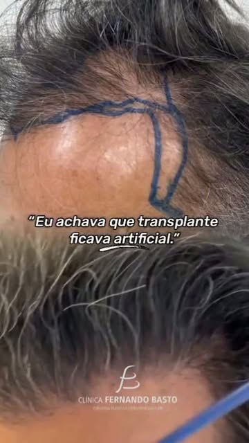 "Eu achava que transplante capilar ficava artificial."
Essa é uma das frases que mais escuto no cons